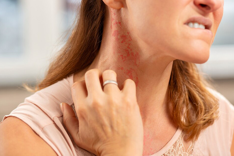 عرق‌سوز شدن با علائمی مانند جوش‌های قرمز یا شفاف، خارش و التهاب همراه است و بیشتر در نواحی مرطوب بدن مشاهده می‌شود.